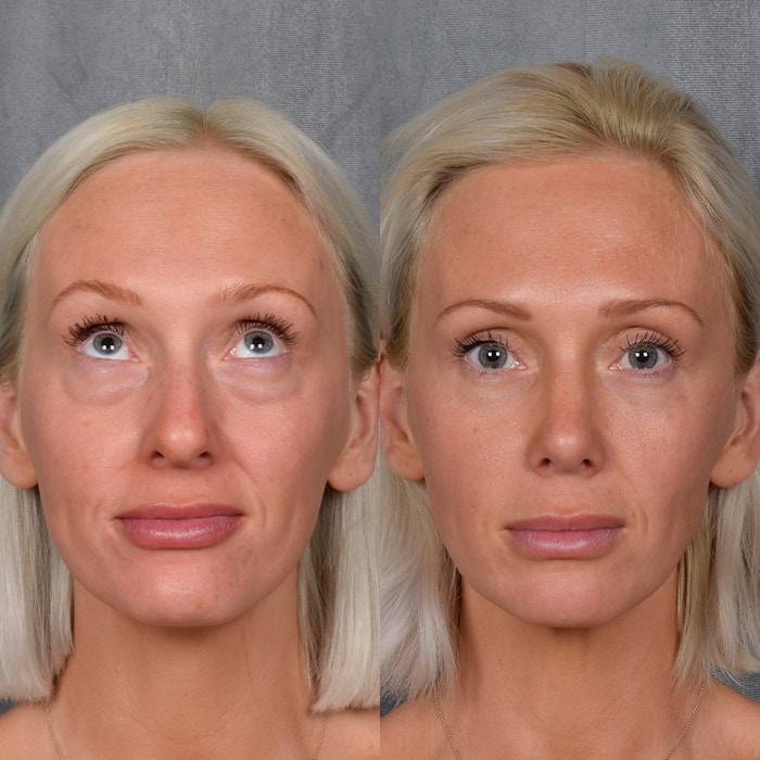 Lower Blepharoplasty Before & After Gallery - Patient 390821 - Image 1