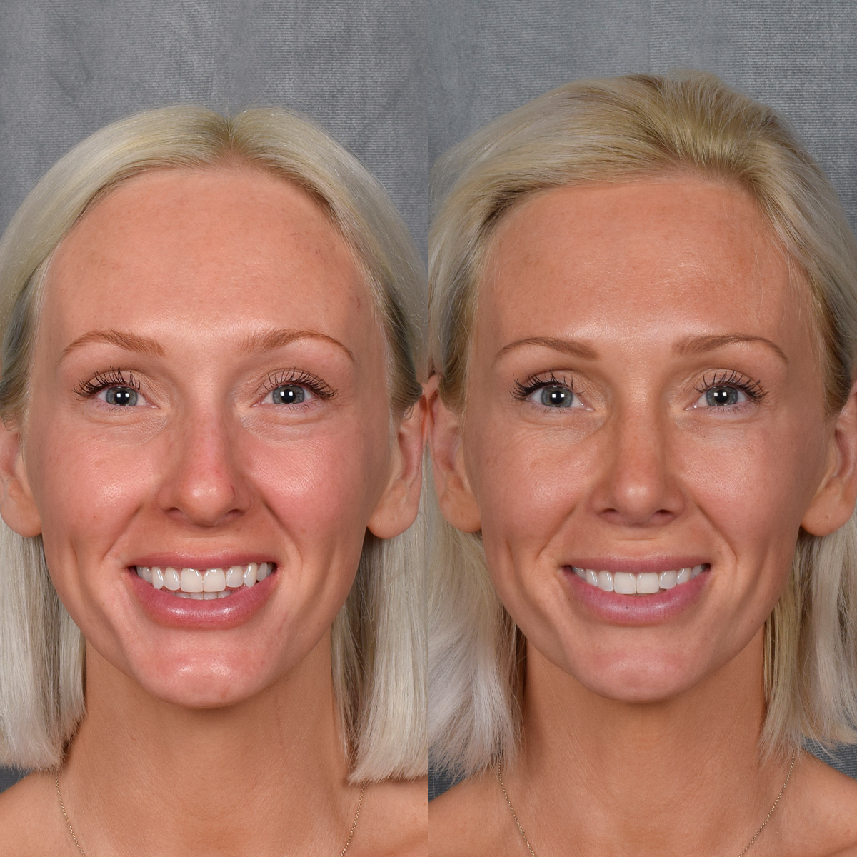 Rhinoplasty Before & After Gallery - Patient 404147 - Image 5