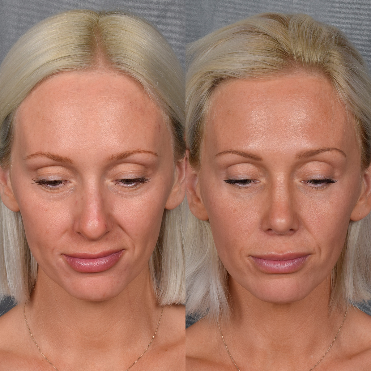 Rhinoplasty Before & After Gallery - Patient 404147 - Image 7