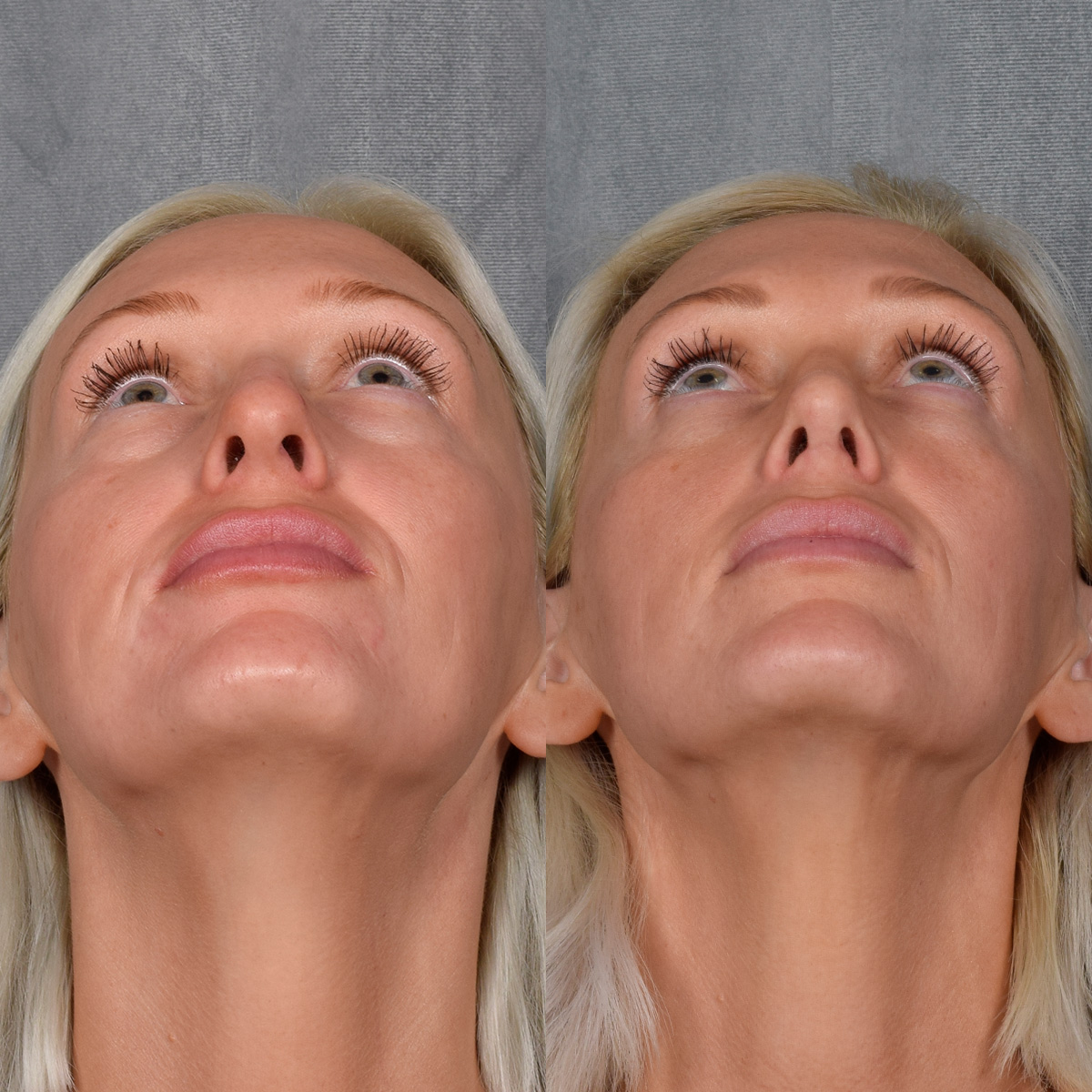 Rhinoplasty Before & After Gallery - Patient 404147 - Image 6