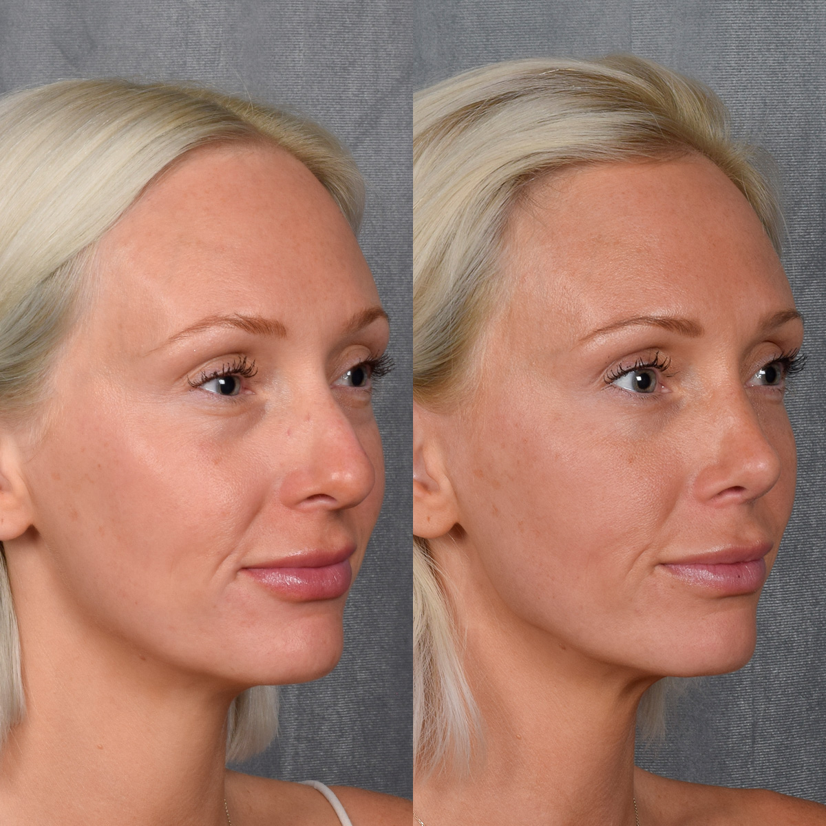 Rhinoplasty Before & After Gallery - Patient 404147 - Image 10