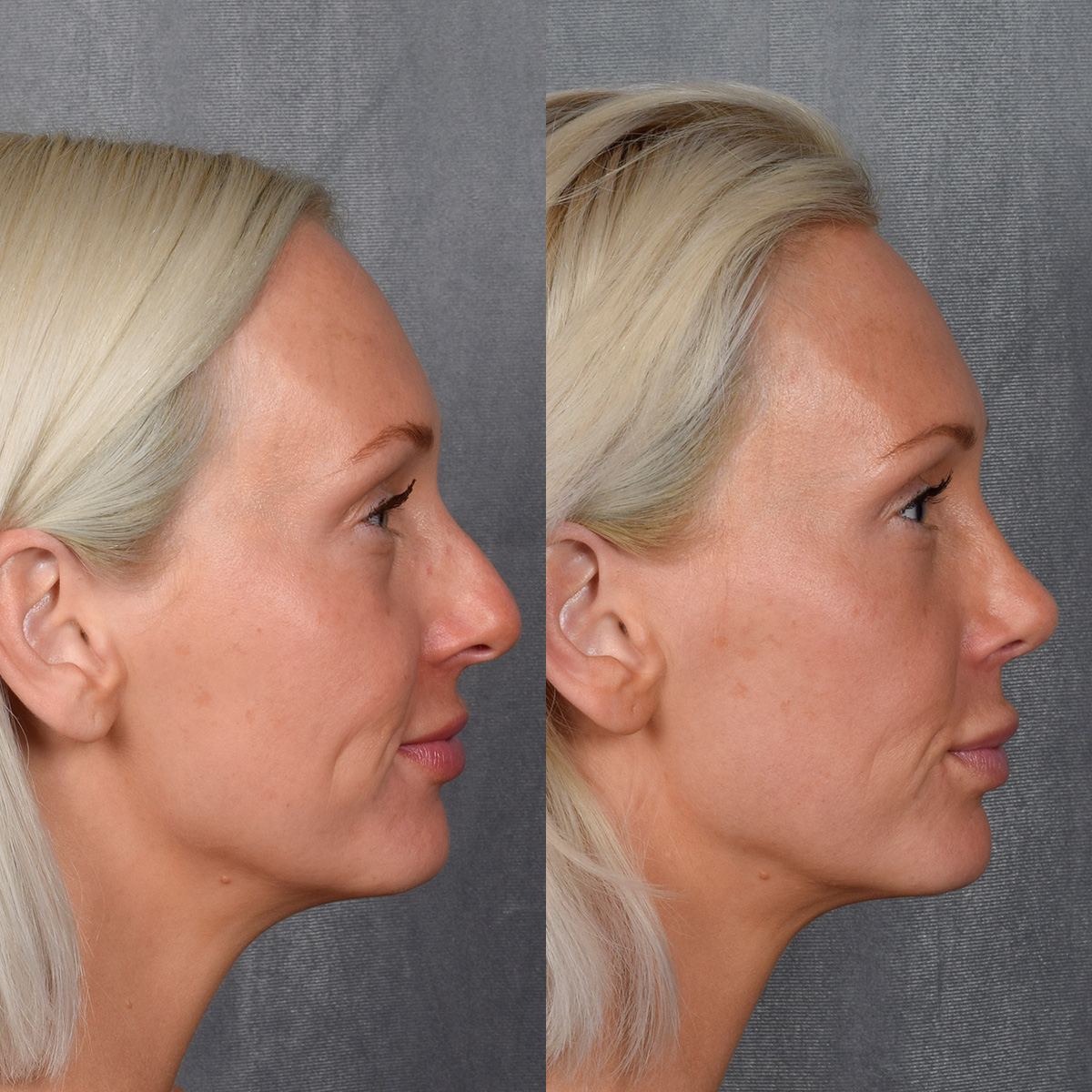 Rhinoplasty Before & After Gallery - Patient 404147 - Image 8