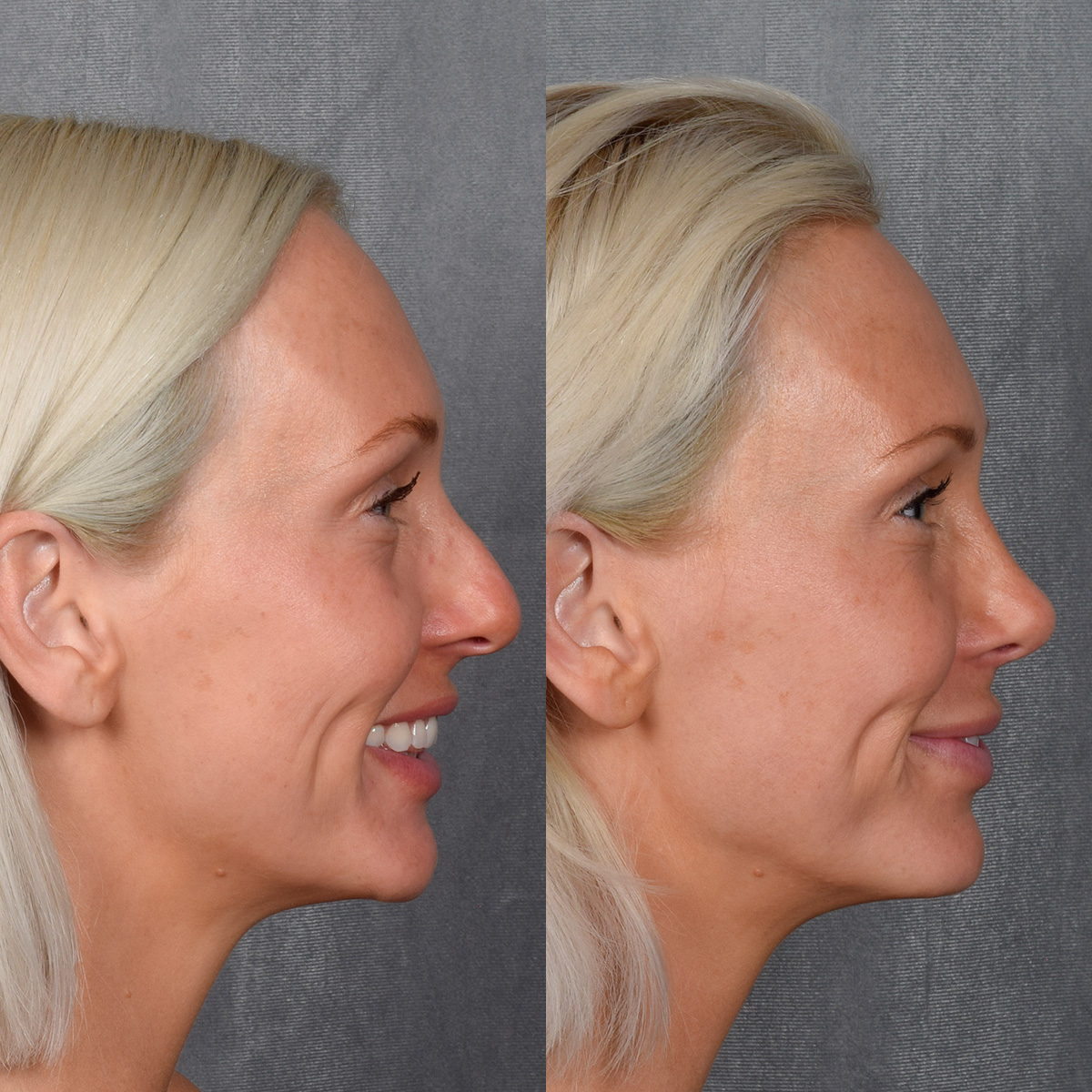 Rhinoplasty Before & After Gallery - Patient 404147 - Image 9