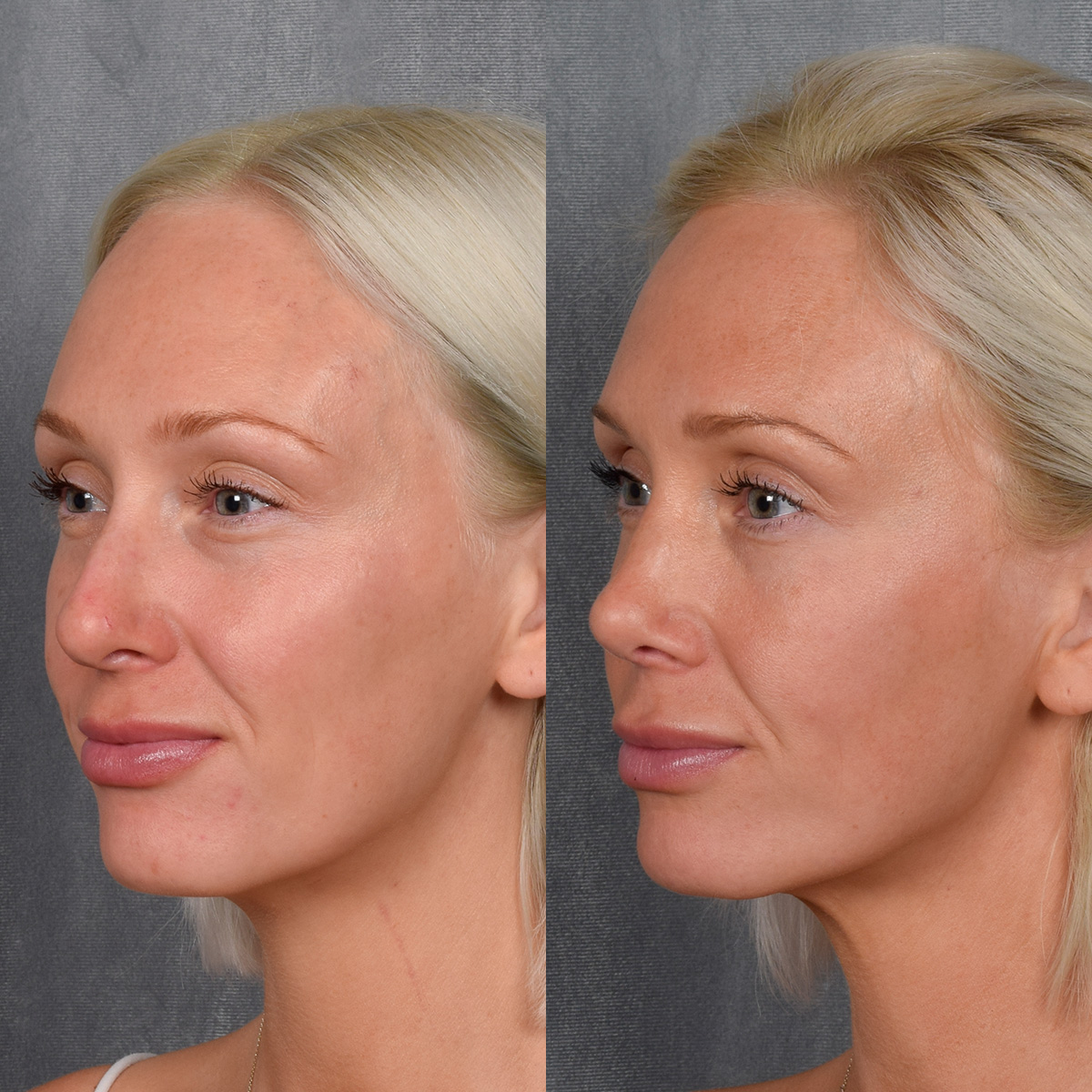 Rhinoplasty Before & After Gallery - Patient 404147 - Image 3