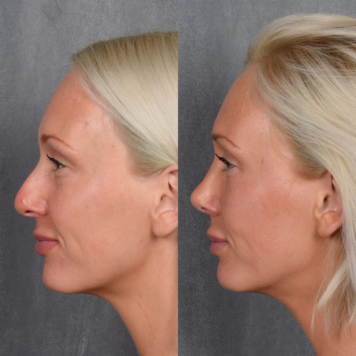 Rhinoplasty Before & After Gallery - Patient 404147 - Image 1