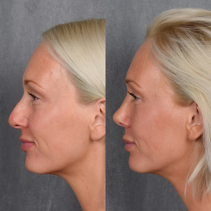 Rhinoplasty Before & After Gallery - Patient 404147 - Image 1