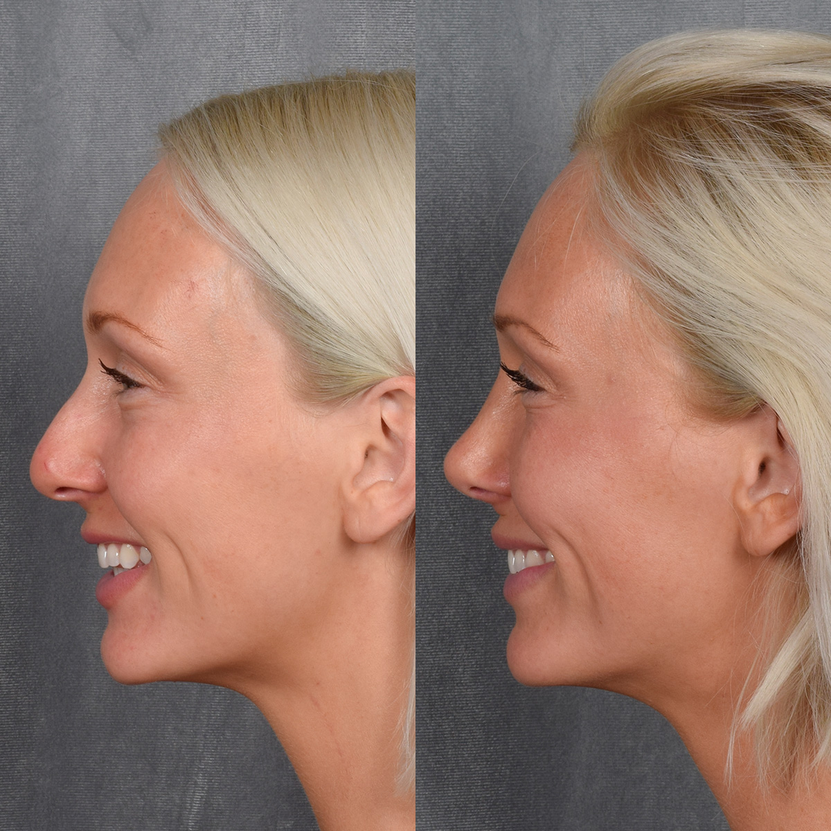 Rhinoplasty Before & After Gallery - Patient 404147 - Image 2