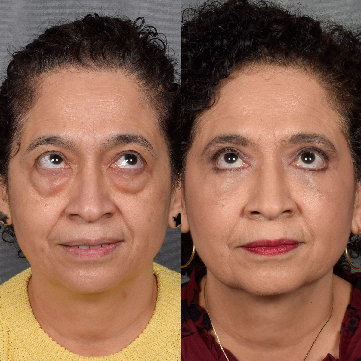 Upper Blepharoplasty Before & After Gallery - Patient 106600 - Image 3