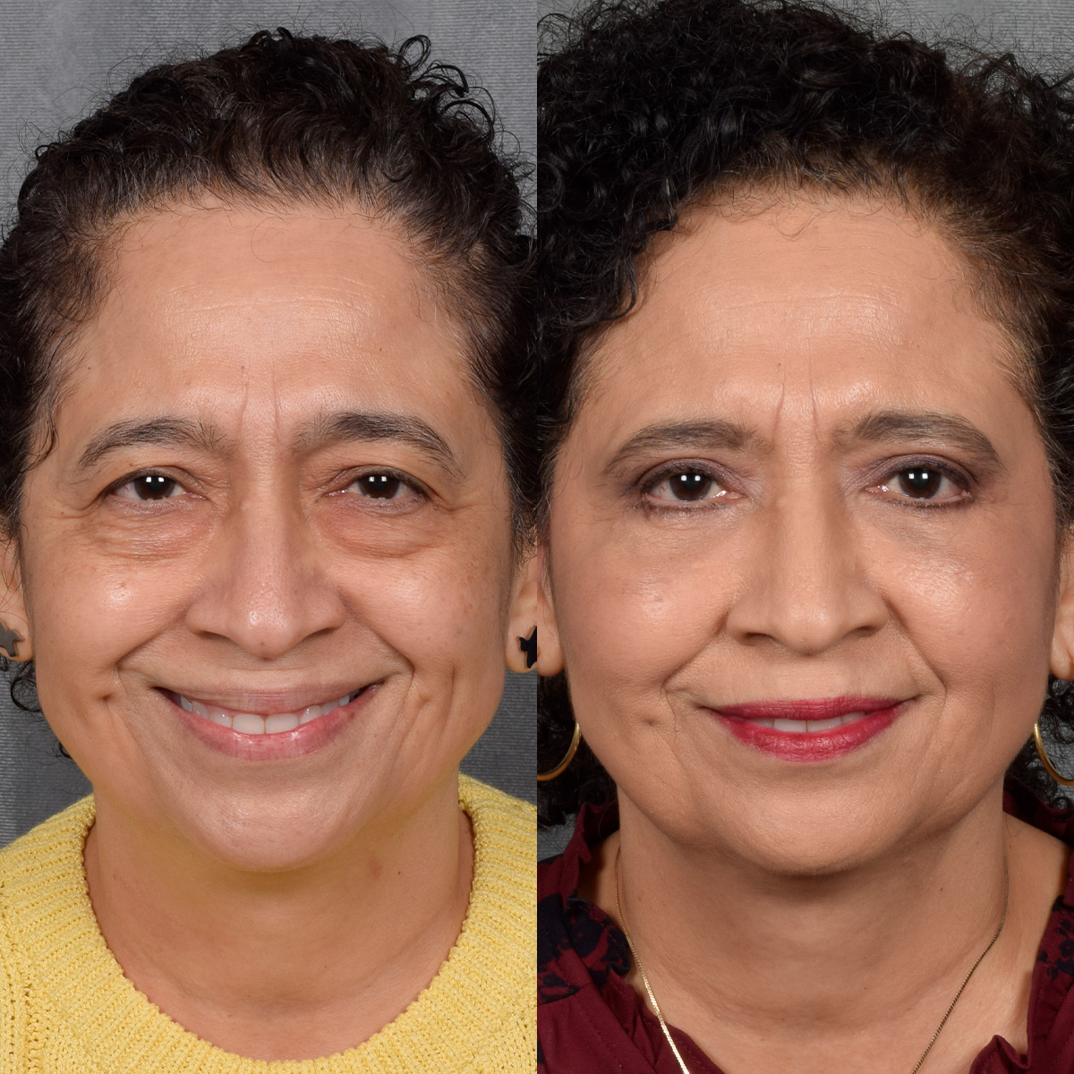 Upper Blepharoplasty Before & After Gallery - Patient 106600 - Image 2