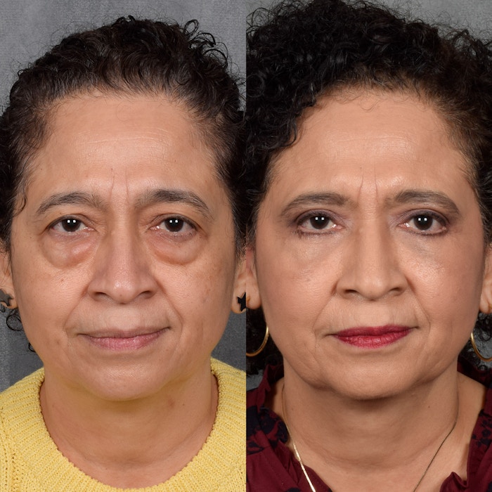 Lower Blepharoplasty Before & After Gallery - Patient 208028 - Image 1