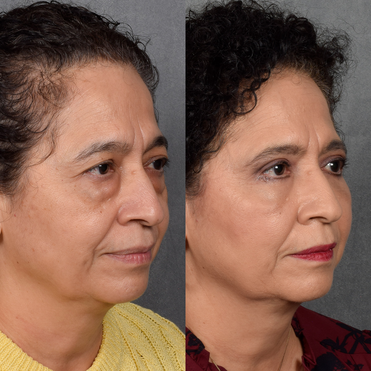 Upper Blepharoplasty Before & After Gallery - Patient 106600 - Image 4