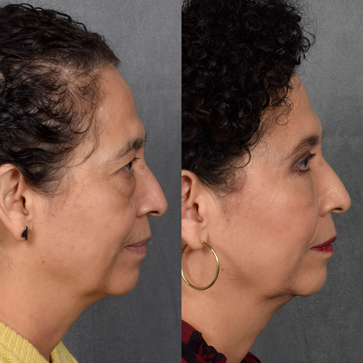 Upper Blepharoplasty Before & After Gallery - Patient 106600 - Image 5