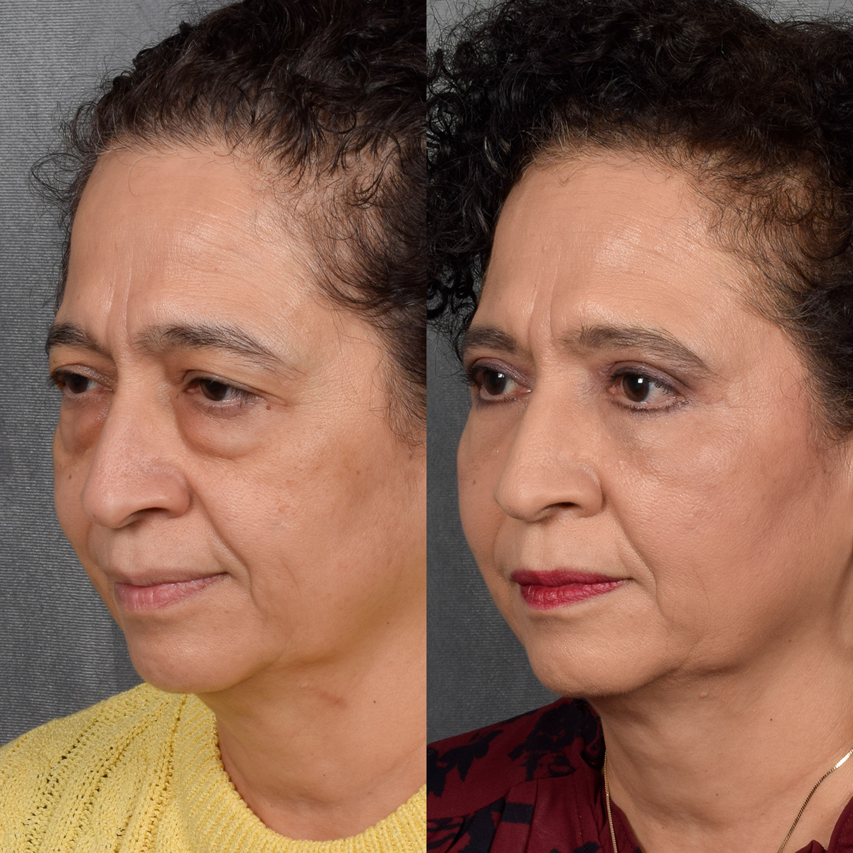 Upper Blepharoplasty Before & After Gallery - Patient 106600 - Image 6