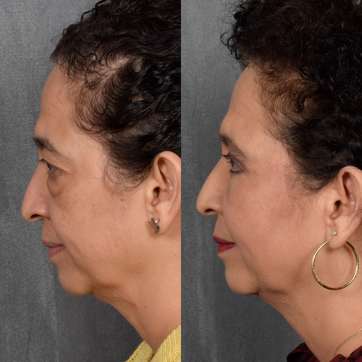 Upper Blepharoplasty Before & After Gallery - Patient 106600 - Image 7