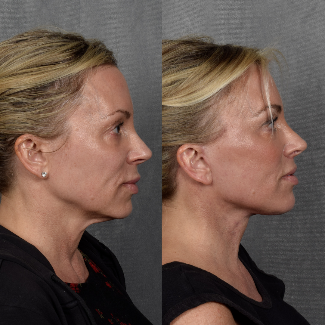 CO2 Laser Before & After Gallery - Patient 352391 - Image 3