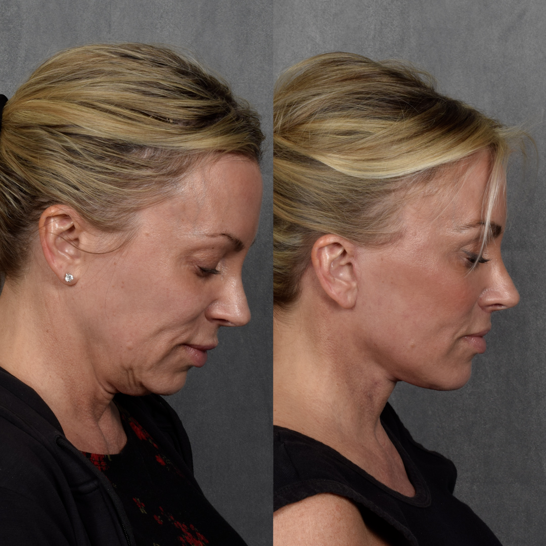 CO2 Laser Before & After Gallery - Patient 352391 - Image 4