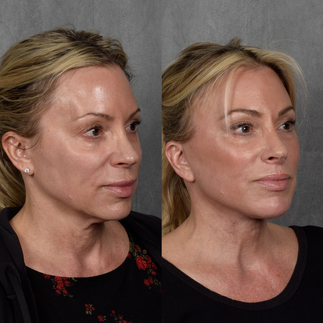 CO2 Laser Before & After Gallery - Patient 352391 - Image 2