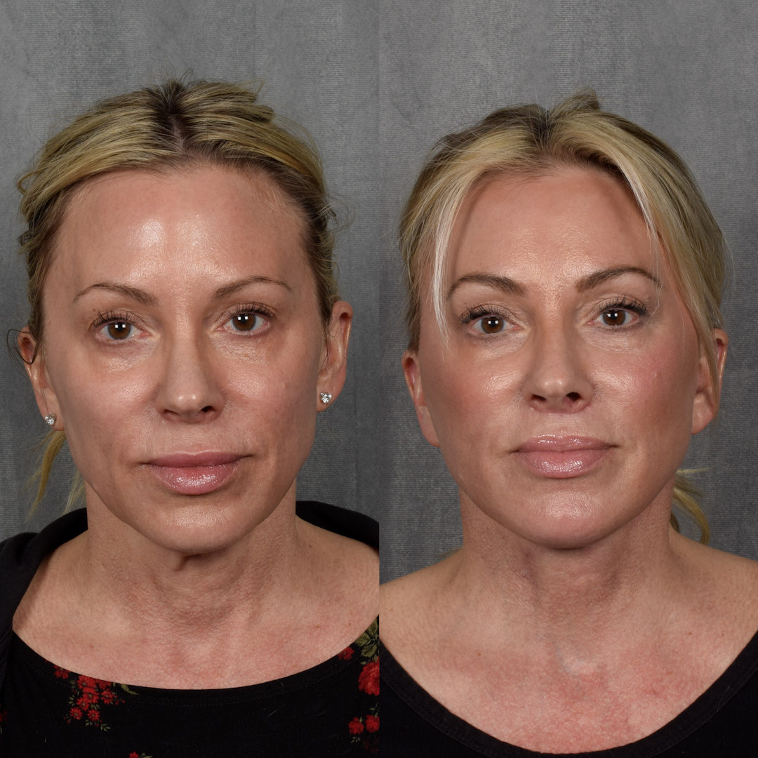 CO2 Laser Before & After Gallery - Patient 352391 - Image 1