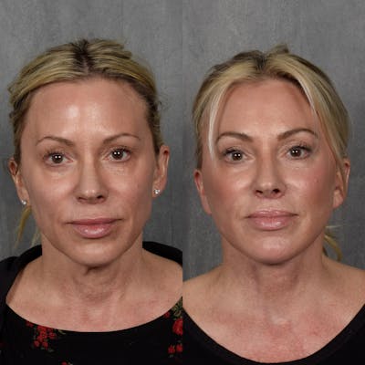 Neck Lift Before & After Gallery - Patient 403049 - Image 1