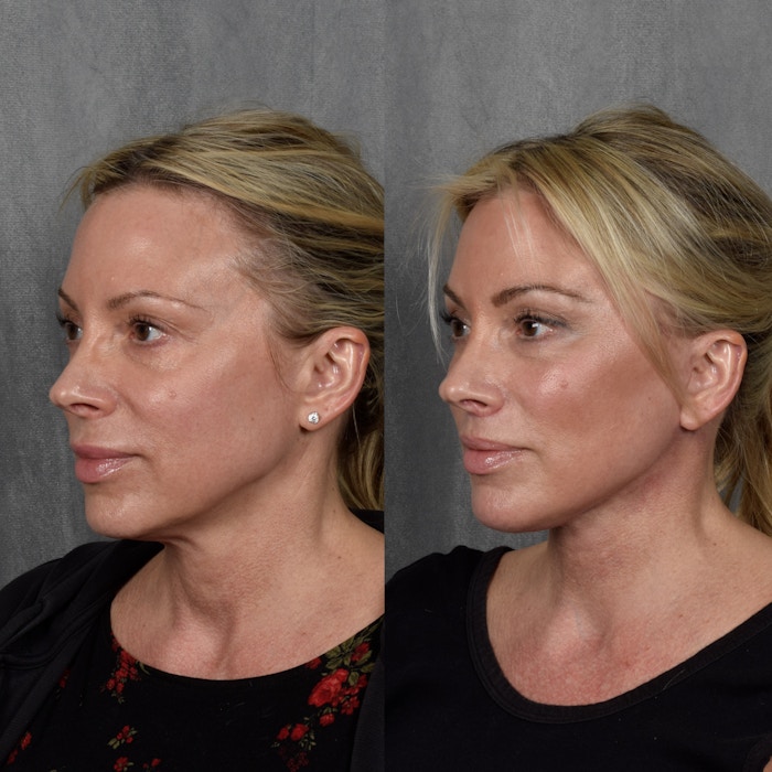 Facelift Before & After Gallery - Patient 422367 - Image 1