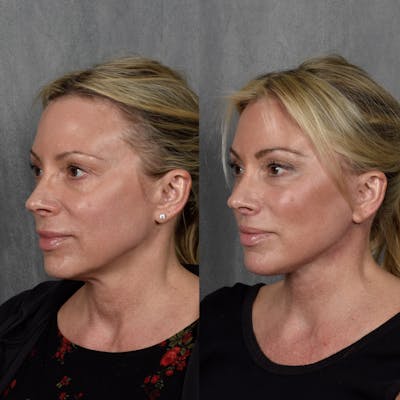 Facelift Before & After Gallery - Patient 422367 - Image 1