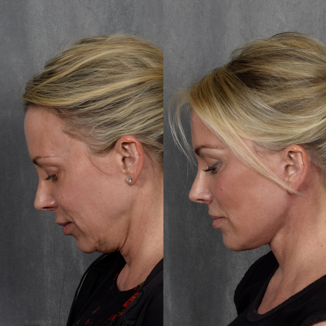 CO2 Laser Before & After Gallery - Patient 352391 - Image 7