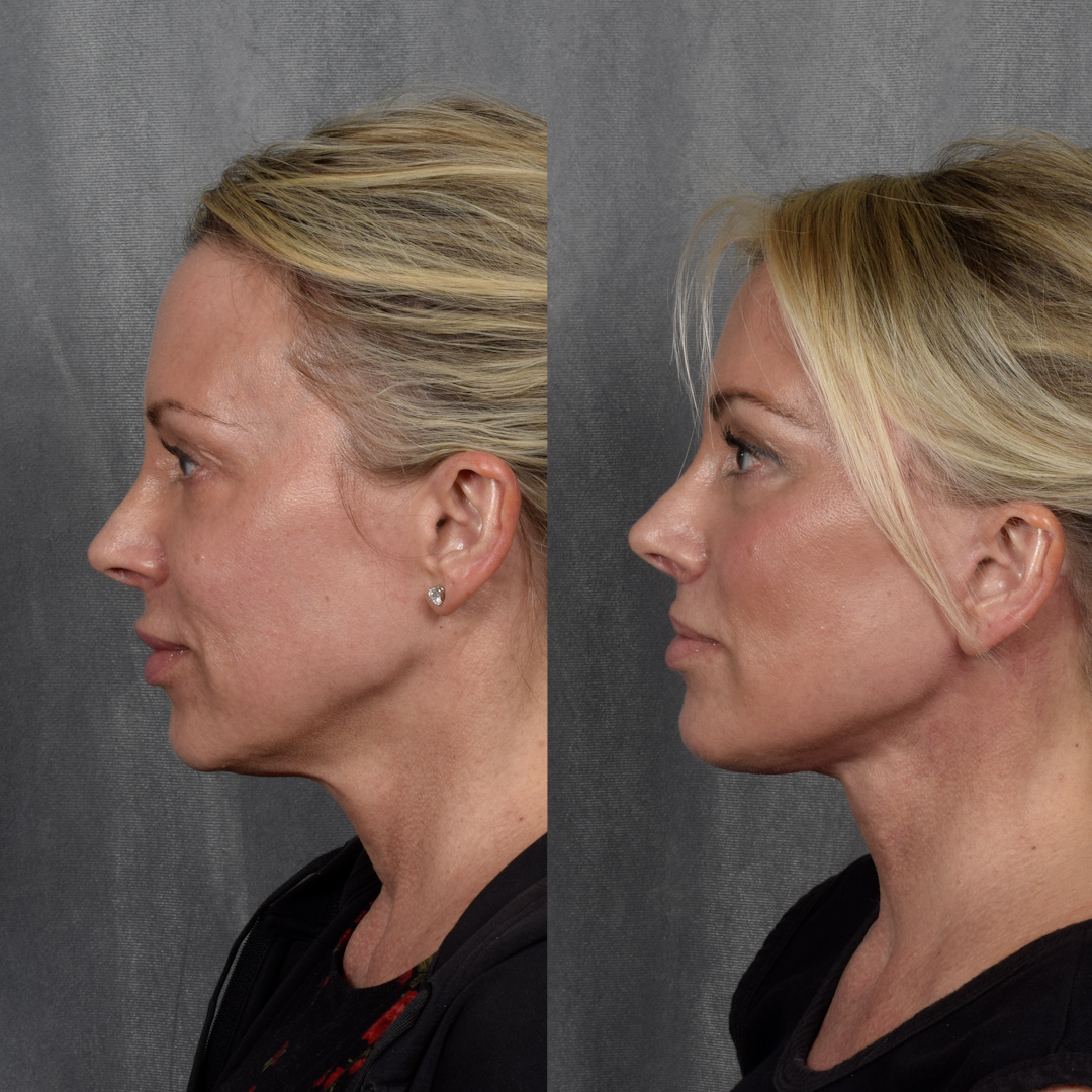 CO2 Laser Before & After Gallery - Patient 352391 - Image 6