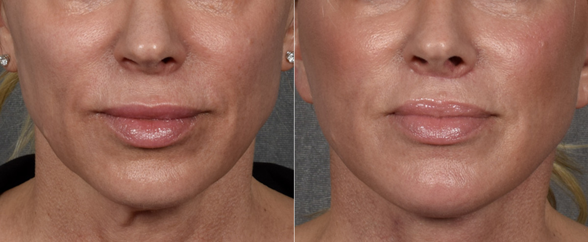 Lip Lift Before & After Gallery - Patient 316975 - Image 1