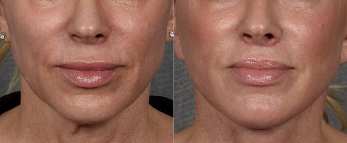 Lip Lift Before & After Gallery - Patient 316975 - Image 1