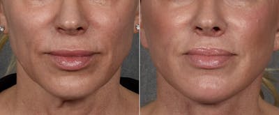 Lip Lift Before & After Gallery - Patient 316975 - Image 1