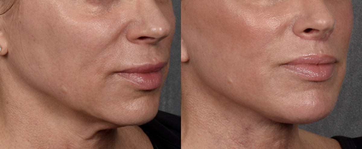 Lip Lift Before & After Gallery - Patient 316975 - Image 2
