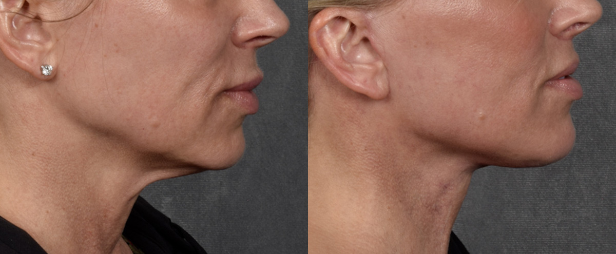 Lip Lift Before & After Gallery - Patient 316975 - Image 3