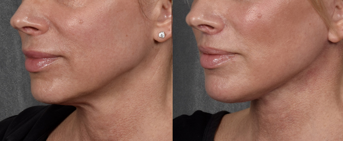 Lip Lift Before & After Gallery - Patient 316975 - Image 4