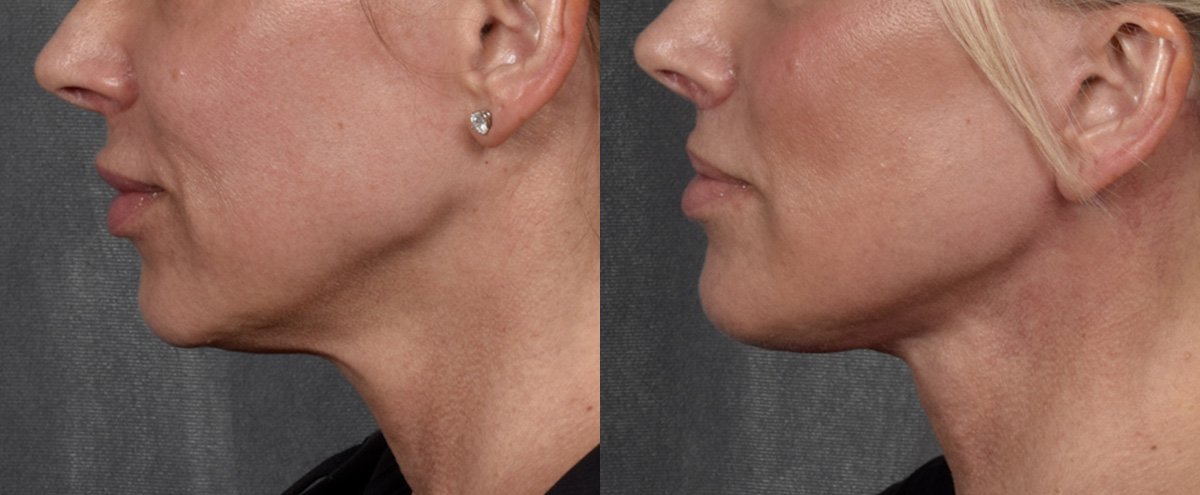 Lip Lift Before & After Gallery - Patient 316975 - Image 5
