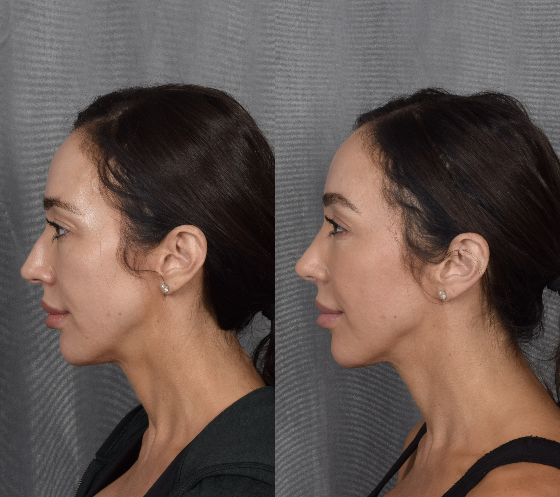 Brow Lift Before & After Gallery - Patient 397854 - Image 7