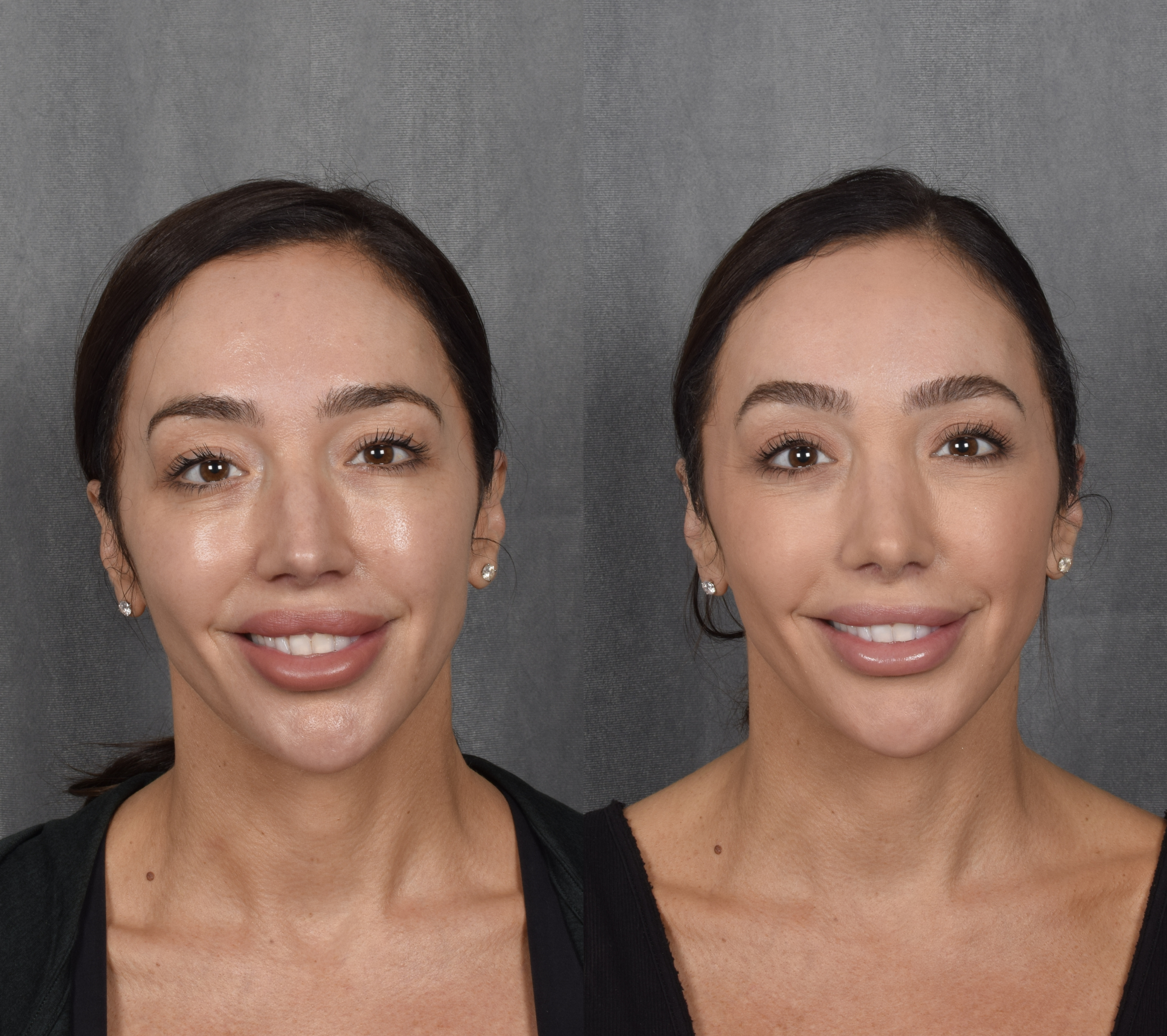 Brow Lift Before & After Gallery - Patient 397854 - Image 2