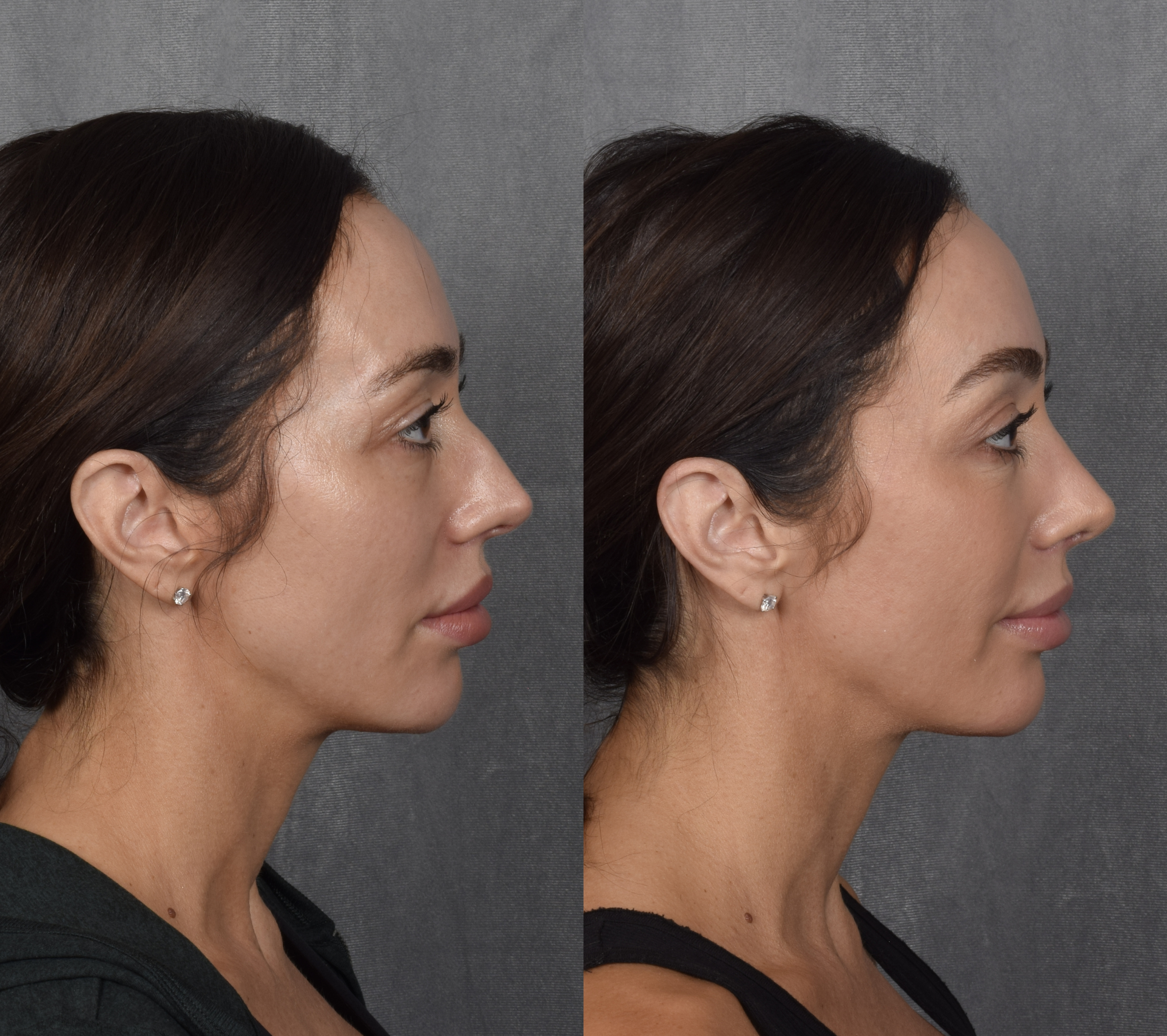 Brow Lift Before & After Gallery - Patient 397854 - Image 4