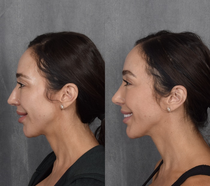 Rhinoplasty Before & After Gallery - Patient 269035 - Image 1