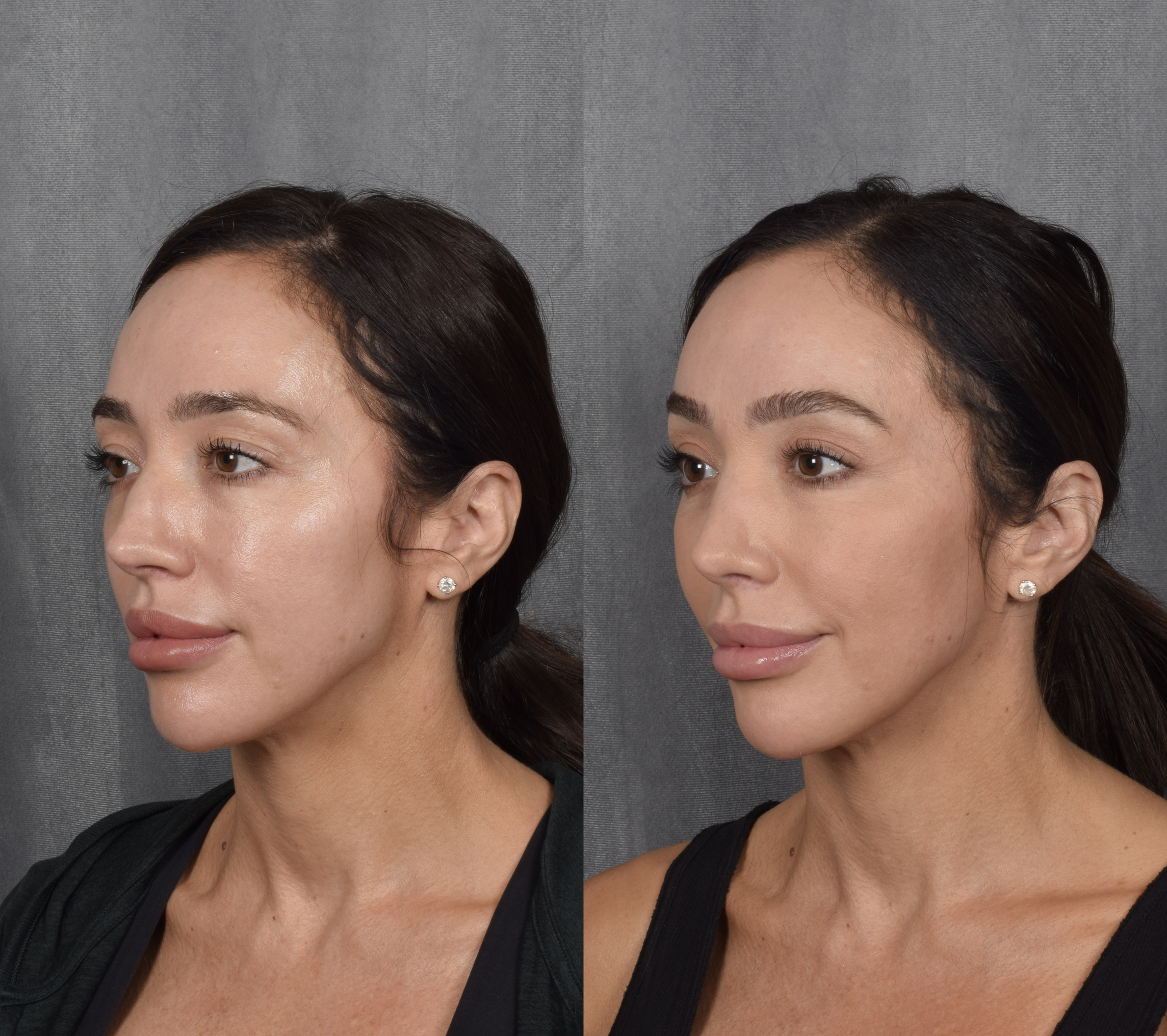 Brow Lift Before & After Gallery - Patient 397854 - Image 6