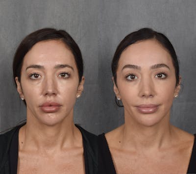 Upper Blepharoplasty Before & After Gallery - Patient 358191 - Image 1