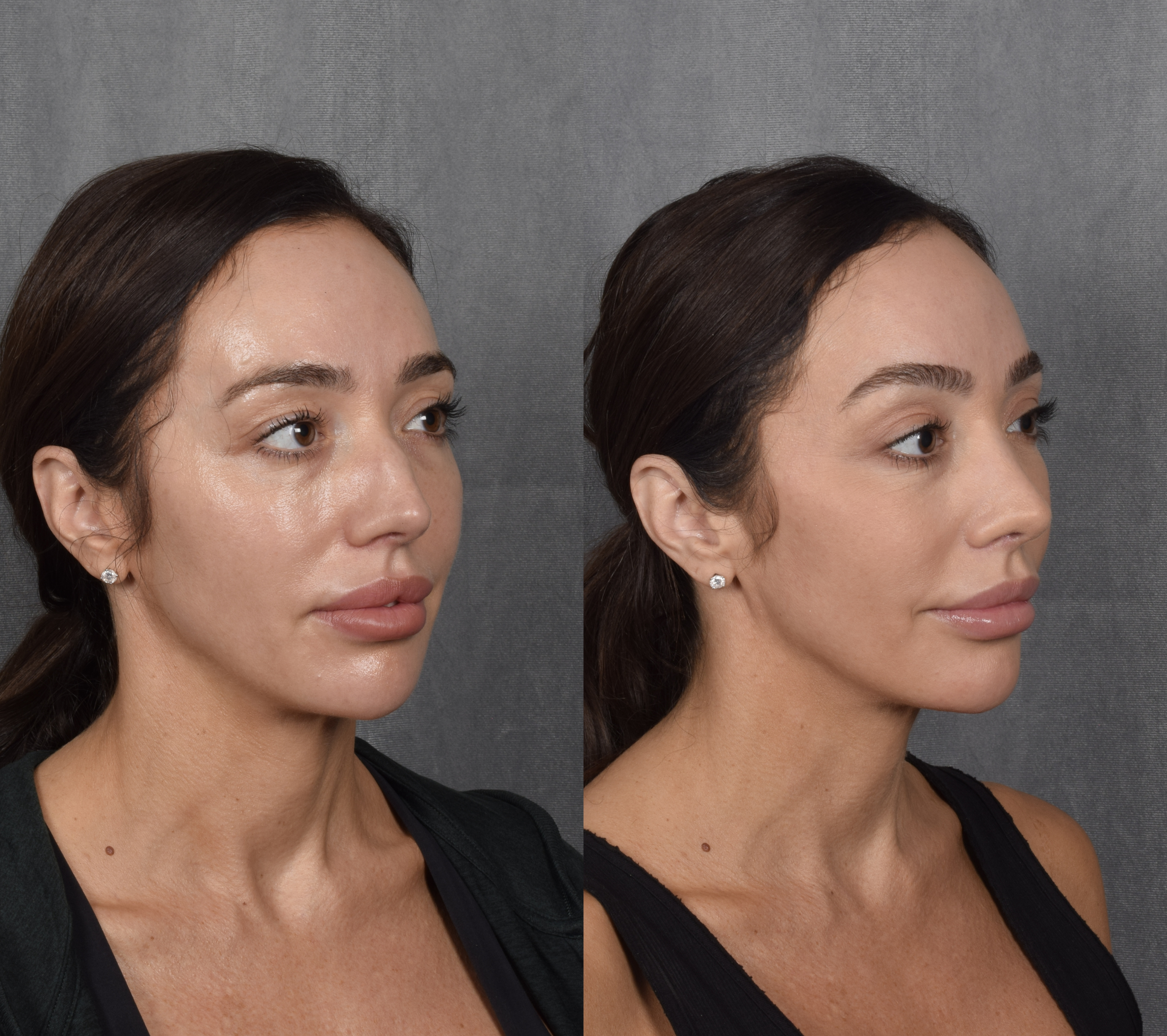 Brow Lift Before & After Gallery - Patient 397854 - Image 3