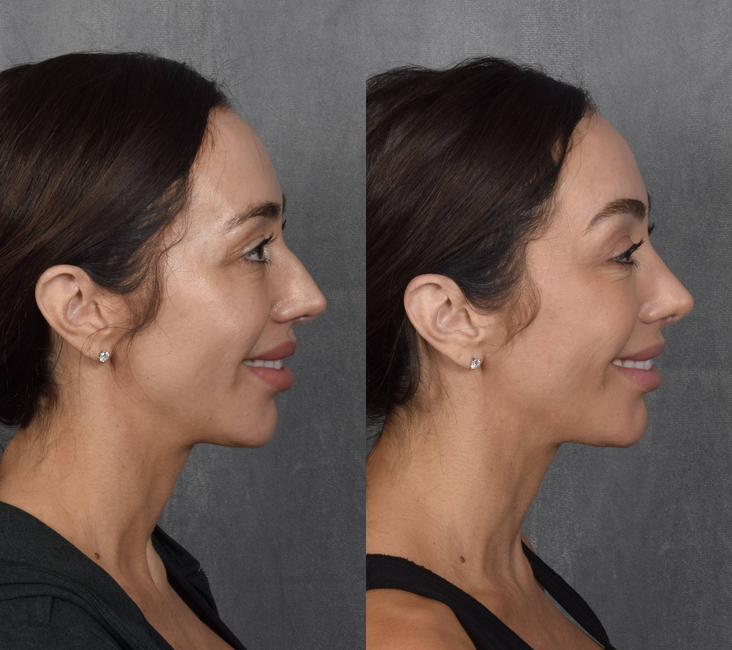 Brow Lift Before & After Gallery - Patient 397854 - Image 5