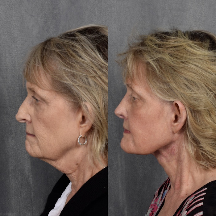 Rhinoplasty Before & After Gallery - Patient 158049 - Image 1