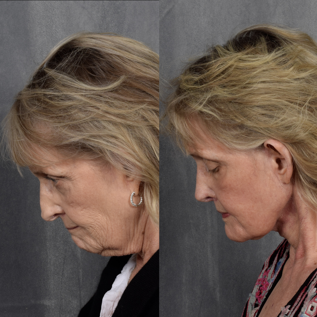 CO2 Laser Before & After Gallery - Patient 945179 - Image 6
