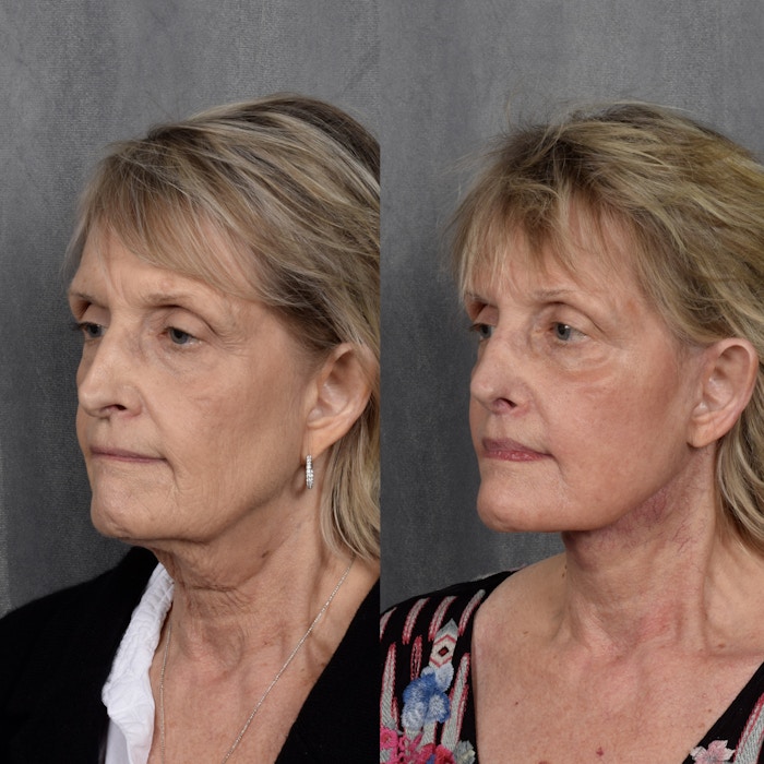 Facelift Before & After Gallery - Patient 407085 - Image 1