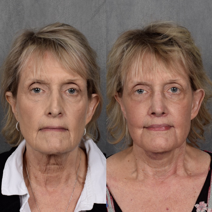 CO2 Laser Before & After Gallery - Patient 945179 - Image 1