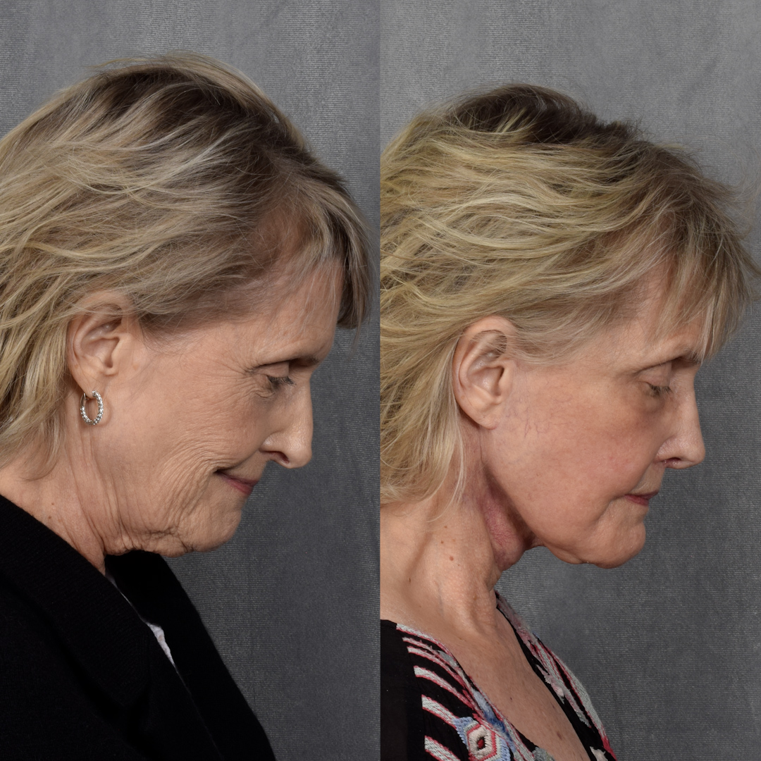 CO2 Laser Before & After Gallery - Patient 945179 - Image 3
