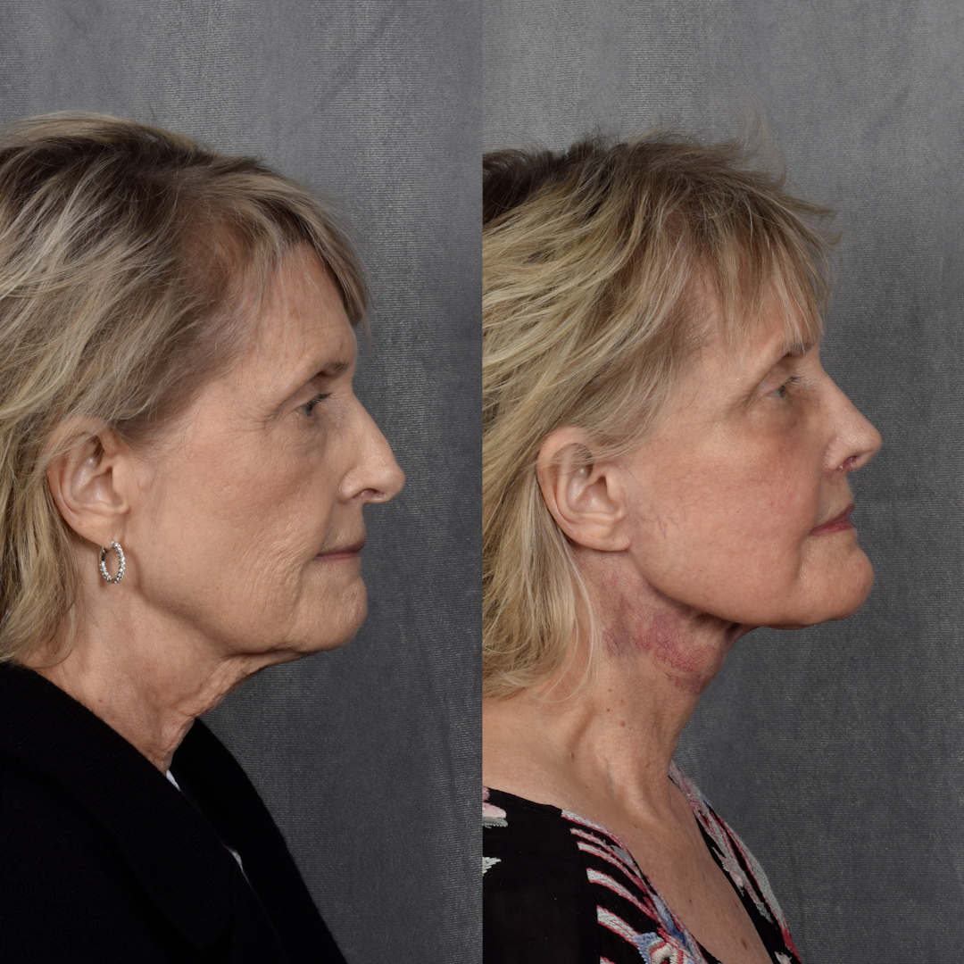 CO2 Laser Before & After Gallery - Patient 945179 - Image 2