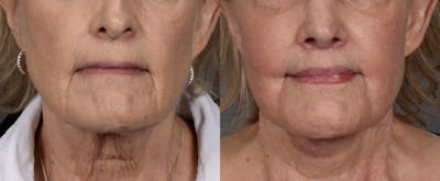 Lip Lift Before & After Gallery - Patient 282611 - Image 1