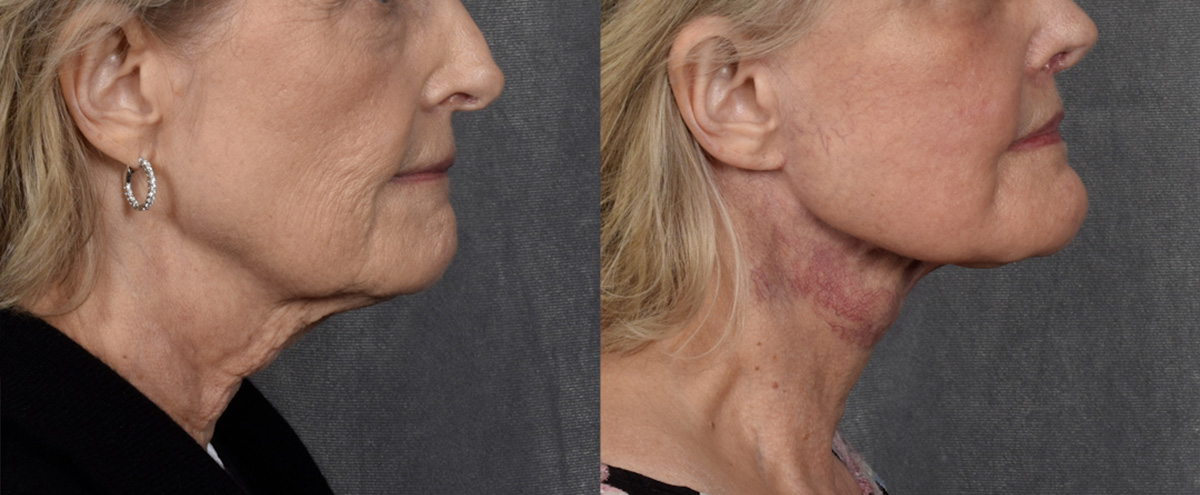 Lip Lift Before & After Gallery - Patient 282611 - Image 4